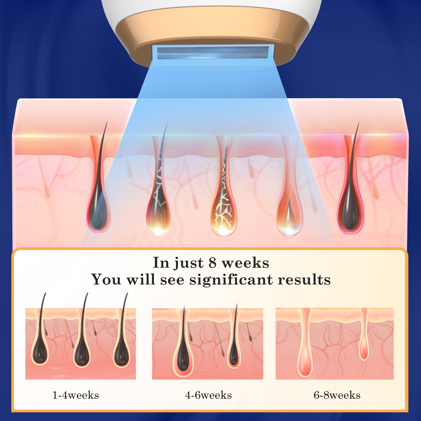Gentle & Long-Lasting Laser Hair Remover - 999,000 Flashes for Body & Face
